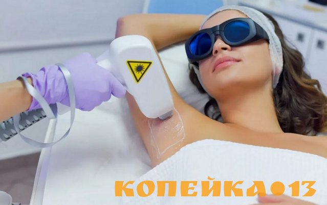 лазерная эпиляция